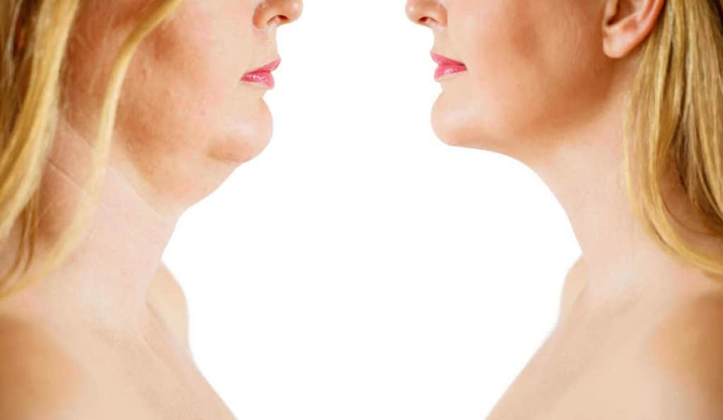Double Chin treatment Kingston Vale before and after results