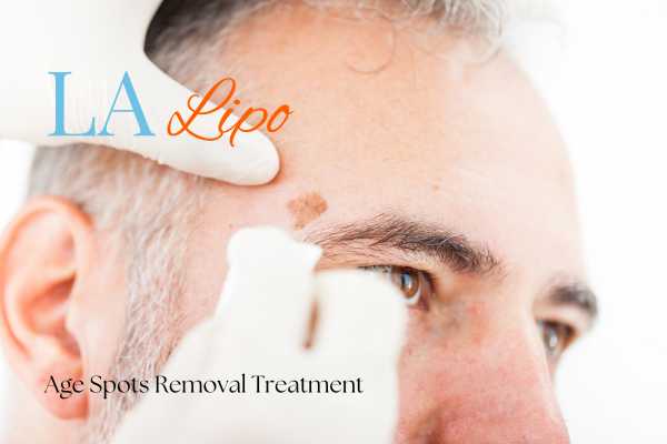 What Are the Most Effective Treatments for Age Spots Kingston Vale?