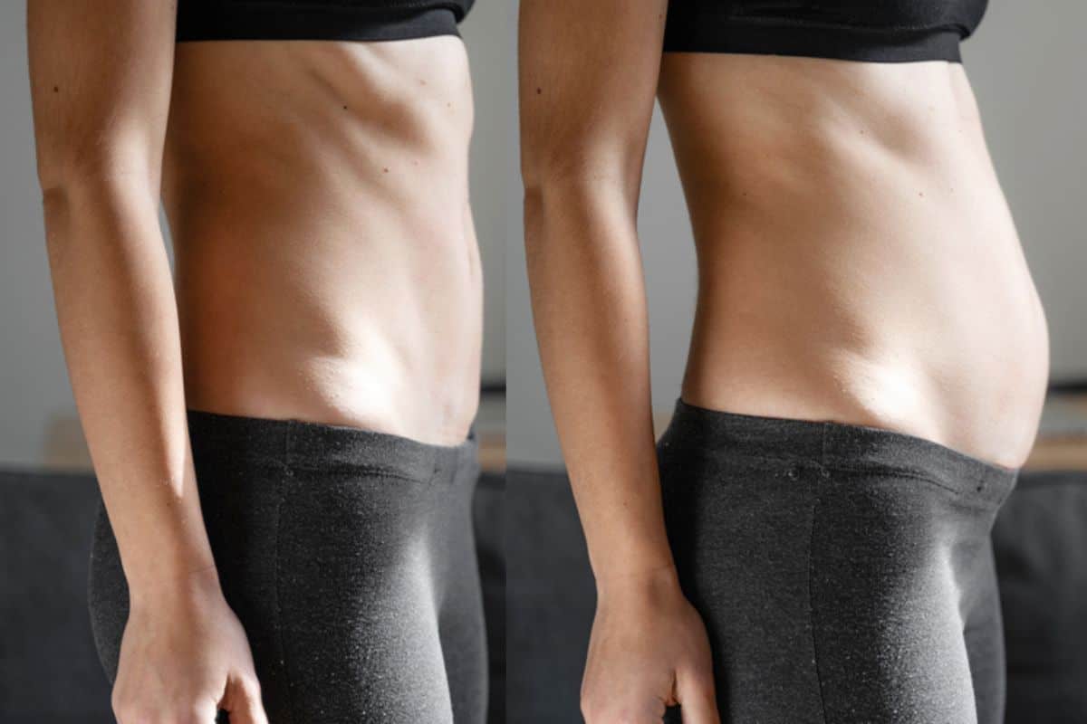 How long does diastasis recti take to improve Kingston Vale?