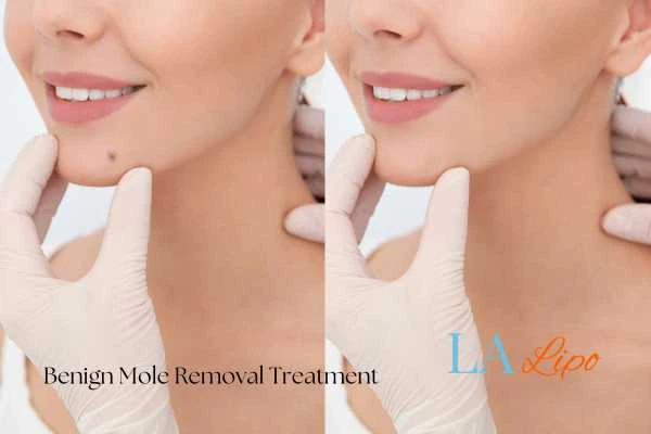 woman's before and after mole removal Kingston Vale results