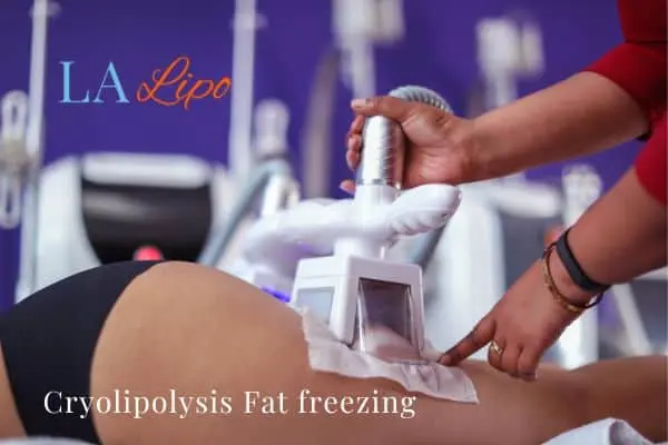 women getting fat freezing Kingston Vale
