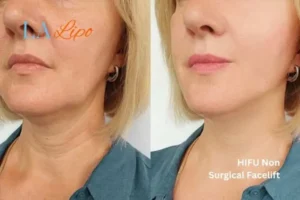 hi-fu for wrinkles Kingston Vale before and after results