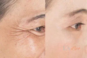 Before and after results of woman - HI-fu wrinkles reduction treatment Kingston Vale
