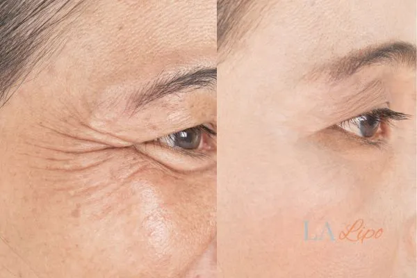 Before and after results of woman - HI-fu wrinkles reduction treatment Kingston Vale