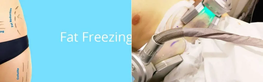 Fat freezing Kingston Vale on multiple areas of the body