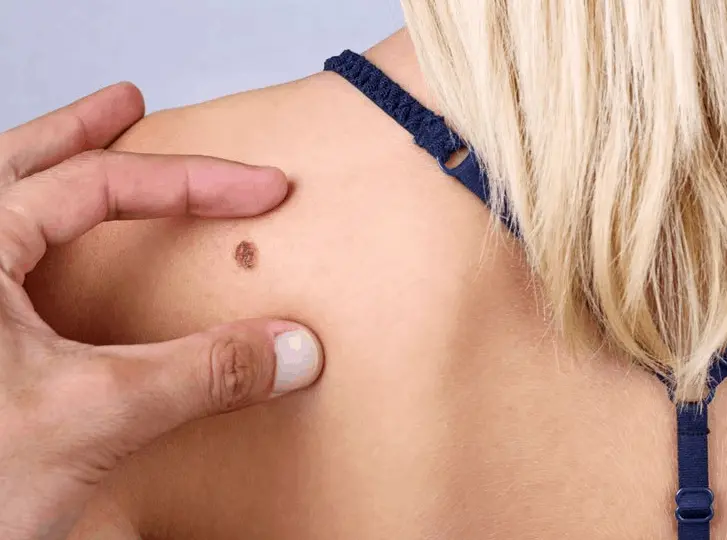 woman having mole removal Kingston Vale consultation before treatment.