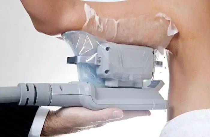 Picture of fat freezing Kingston Vale on the upper arms.