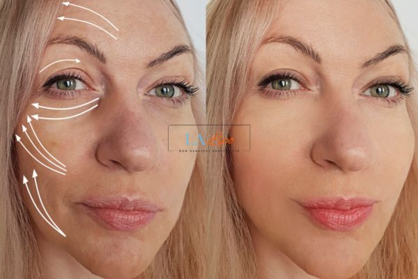 Morpheus 8 results Kingston Vale face lift.