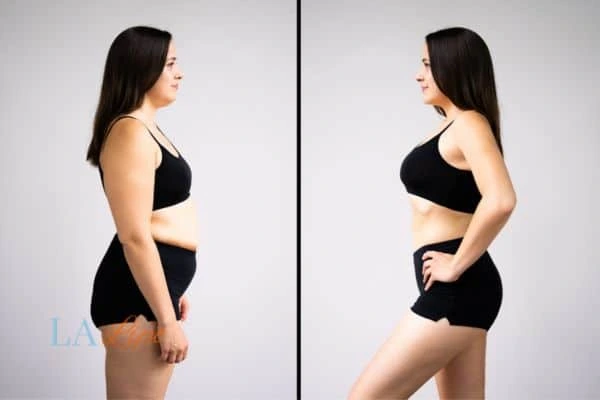 Picture of womans before and after using LA-EMS body sculpting to improve her core strength Kingston Vale