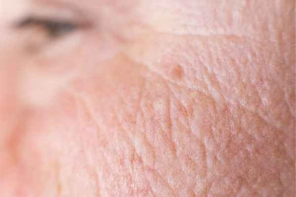 close up picture of a woman's face showing an age spot Kingston Vale