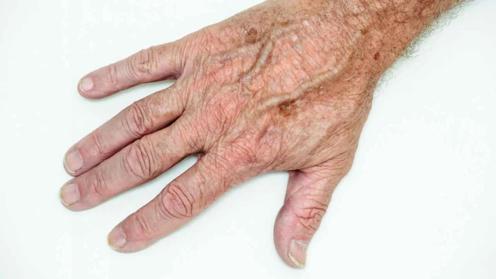 Male hand showing age spot Kingston Vale