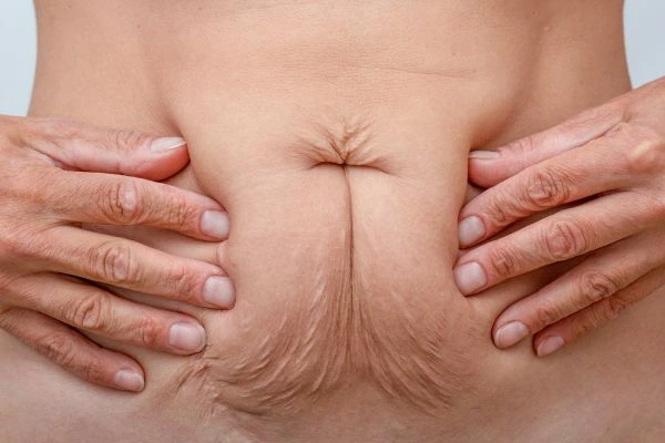 Should I Combine Diastasis Recti Treatment with Body Contouring for Better Results Kingston Vale?