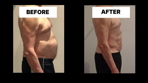 What Symptoms Can Diastasis Recti Cause in Men? Weak Core, Back Pain and Poor Posture Kingston Vale